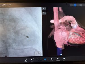 gallino corazón y marcapasos